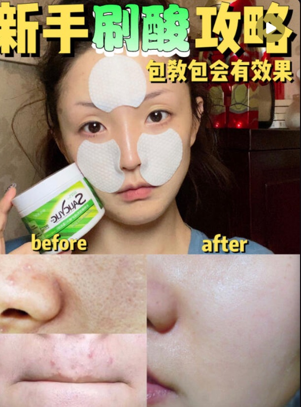 💕STRIDEX水楊酸棉片