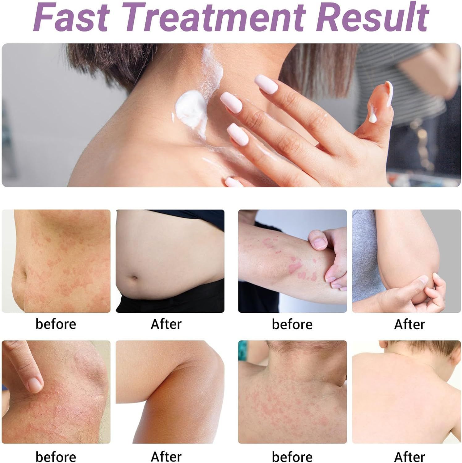 美國代購 蕁麻疹霜 快速緩解蕁麻疹、過敏性皮疹、皮膚搔癢、發紅、腫脹